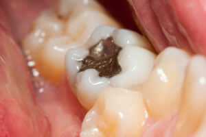 Dental Amalgam | Lowcountry Family Dentistry | Beaufort SC Dentist