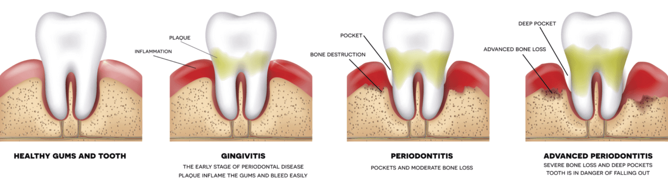 Gum Disease Progression