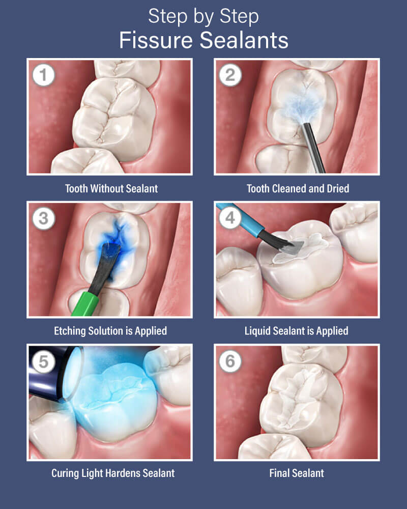 Этапы герметизации фиссур инвазивным методом