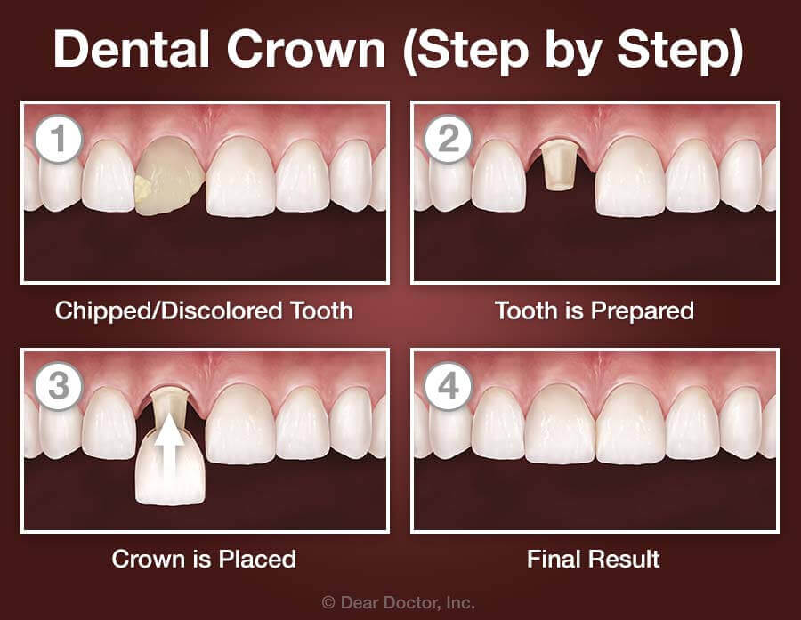Are Dental Crowns Worth It?