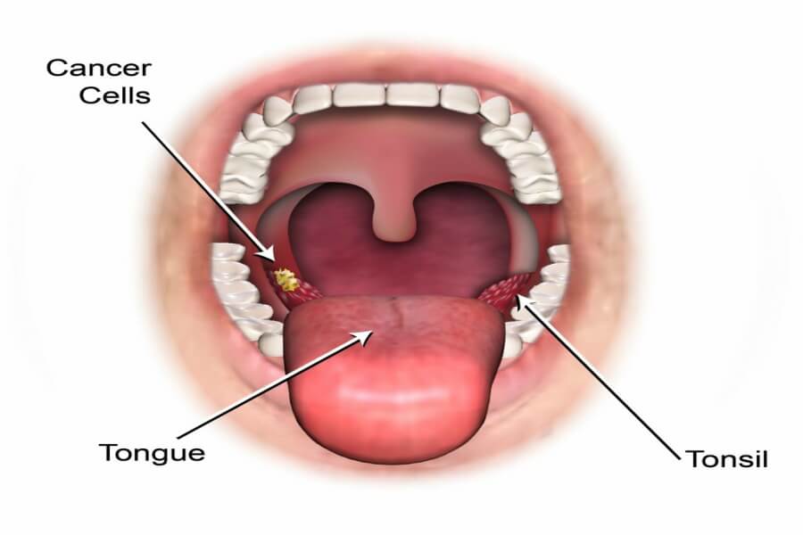 hpv throat cancer signs and symptoms