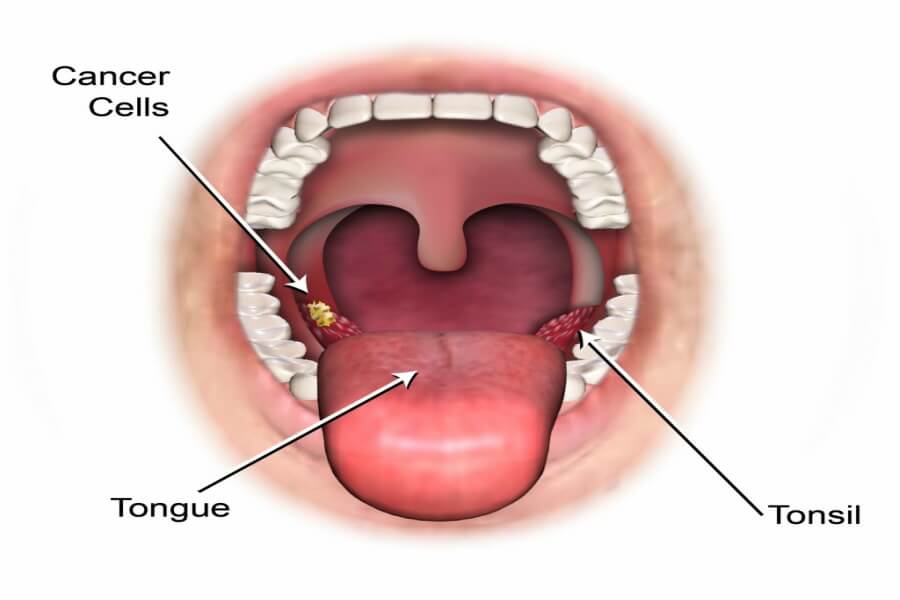 hpv throat cancer symptoms