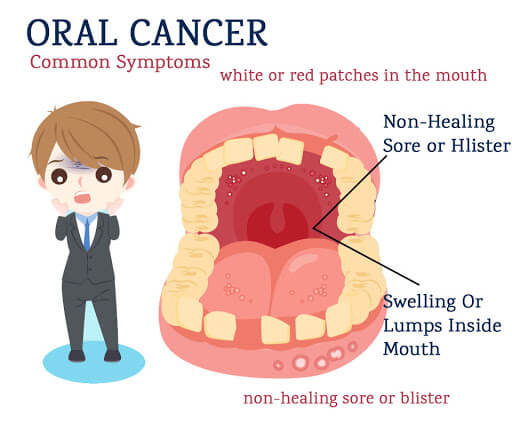 hpv cancer in mouth symptoms