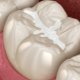 Dental Sealant in Beaufort SC