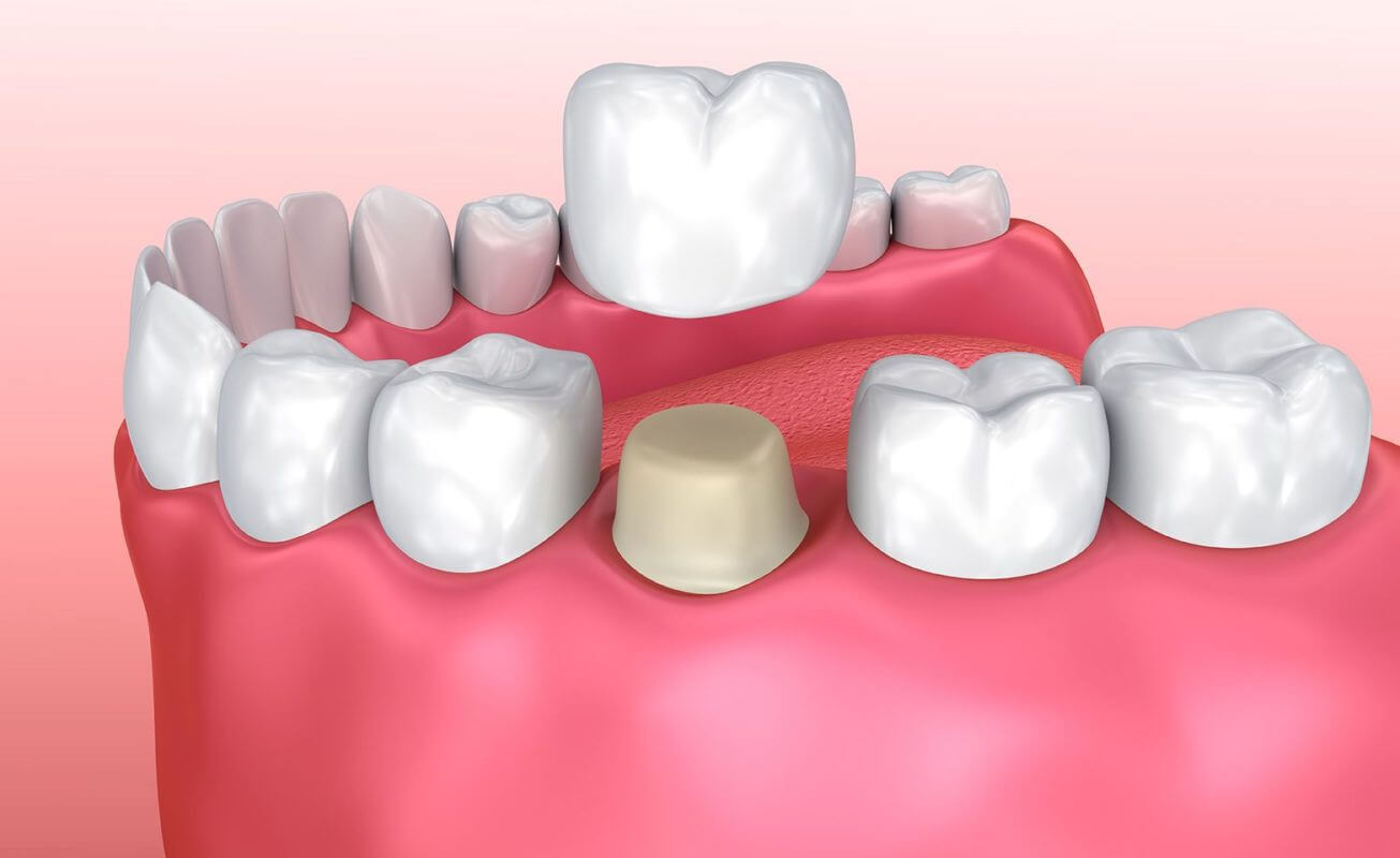 dental crown in Beaufort SC