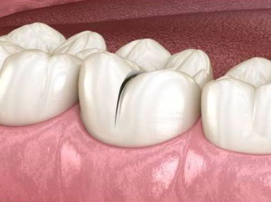 Cracked Tooth: Types, Symptoms & Treatments - Lowcountry Family