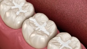 Dental Sealants Beaufort SC